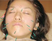 美容鍼最新情報