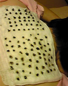 ガーゼ灸イメージ